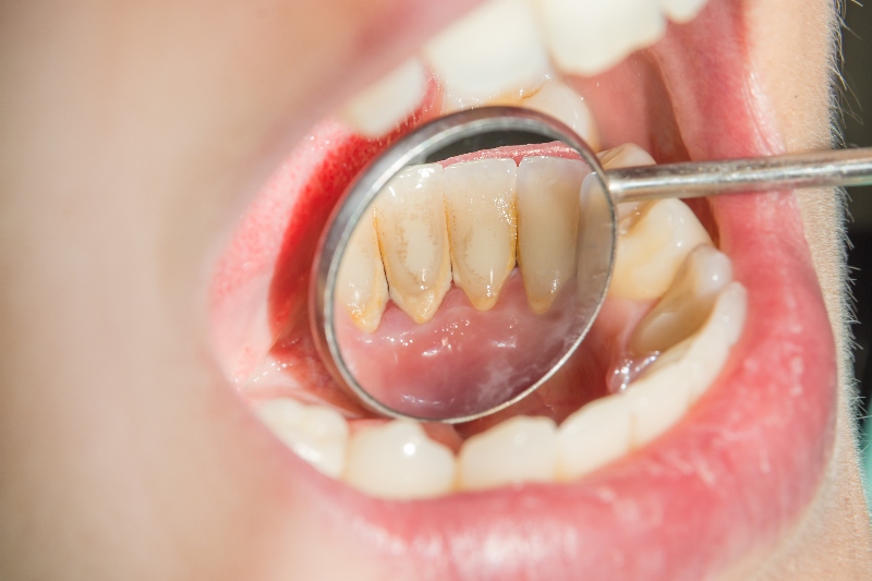 Why Do Gums Bleed While Brushing And What Are The Ways To Prevent
