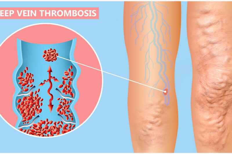 Critical Symptoms Of Deep Vein Thrombosis You Should Know - ACTIV LIVING  COMMUNITY
