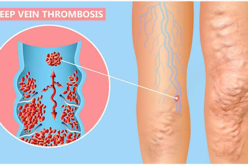 venous thrombosis_Activ Living Community