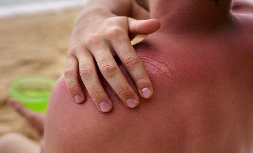 view-man-applying-lotion-sunburn-skin-beach (1)_Activ living Community