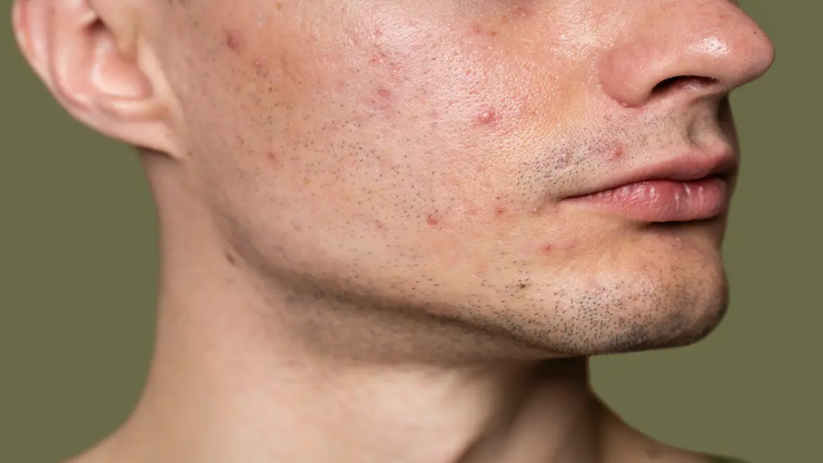 confident-handsome-man-with-acne_Activ Living Community