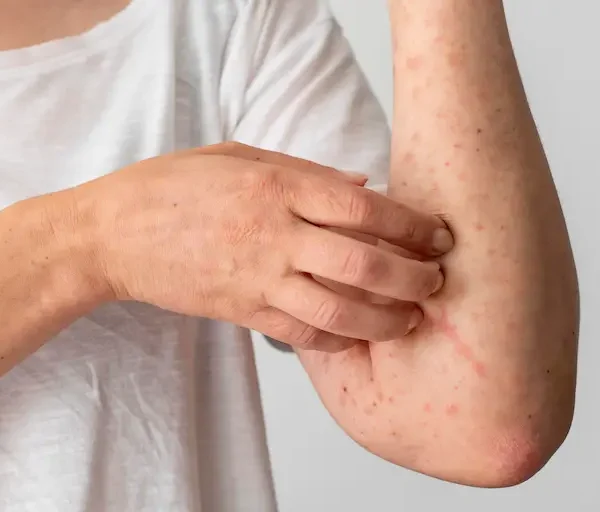 skin-allergy-reaction-person-s-arm_Activ Living Community