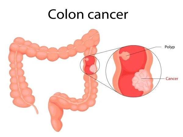 colon cancer